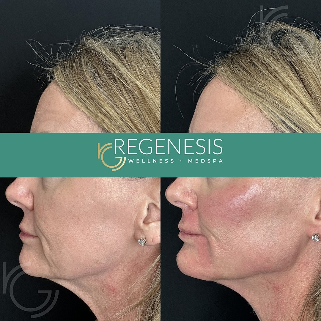 Dermal Fillers Before & After