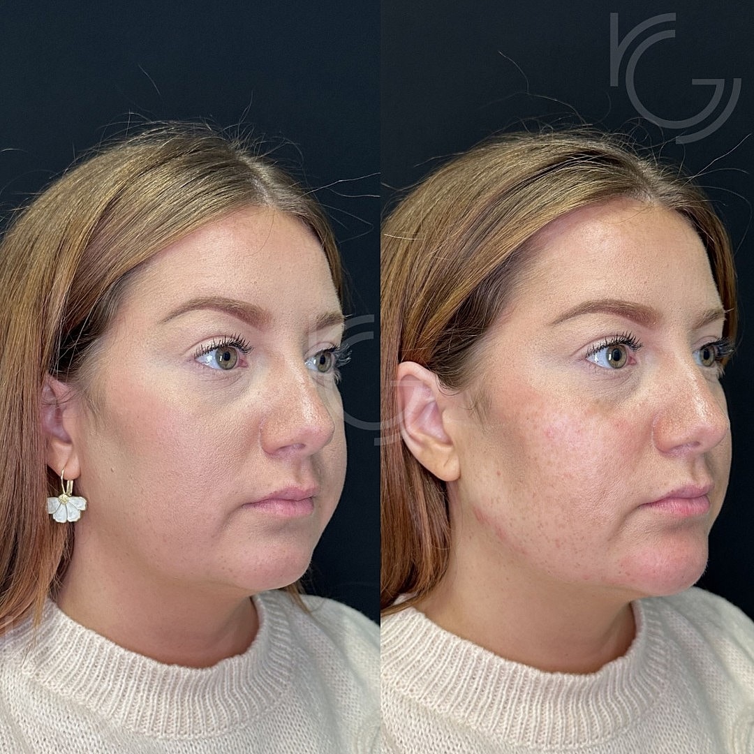 Dermal Fillers Before & After