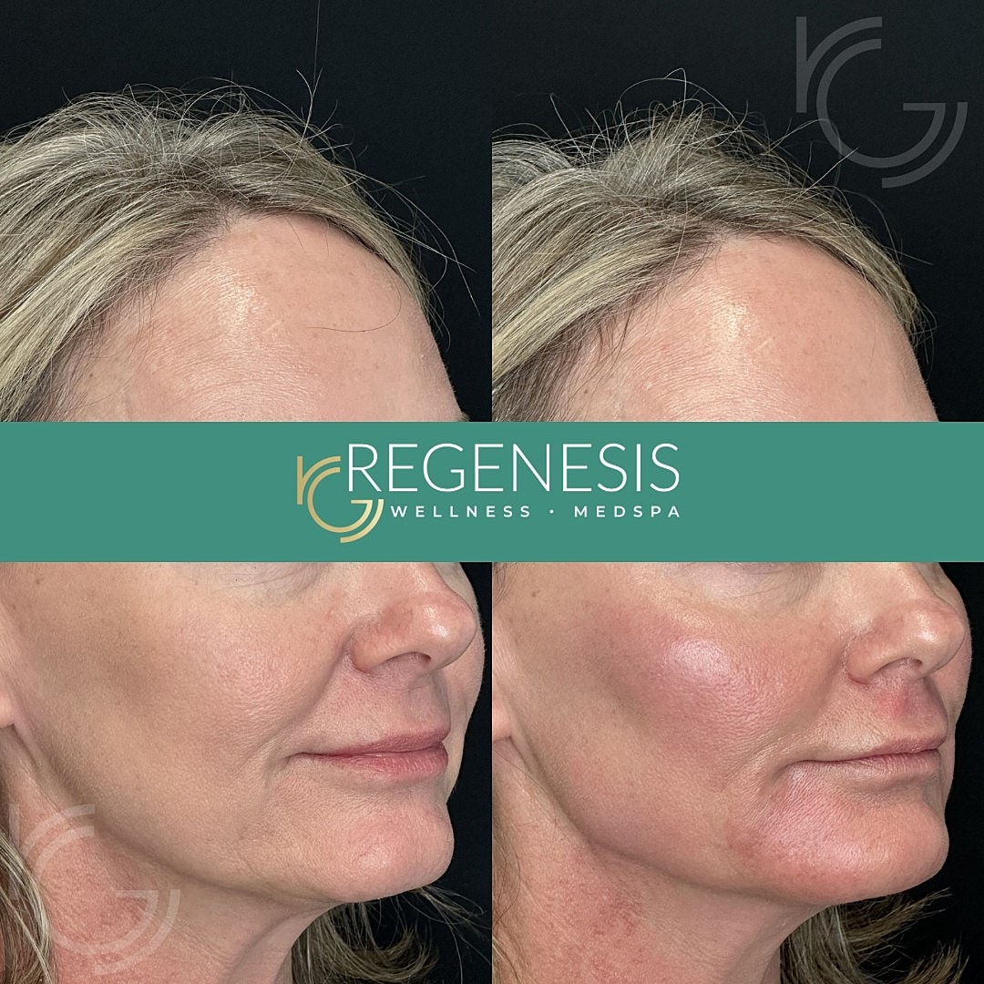 Dermal Fillers Before & After