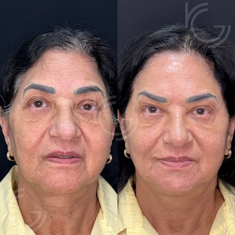 Botox Before & After
