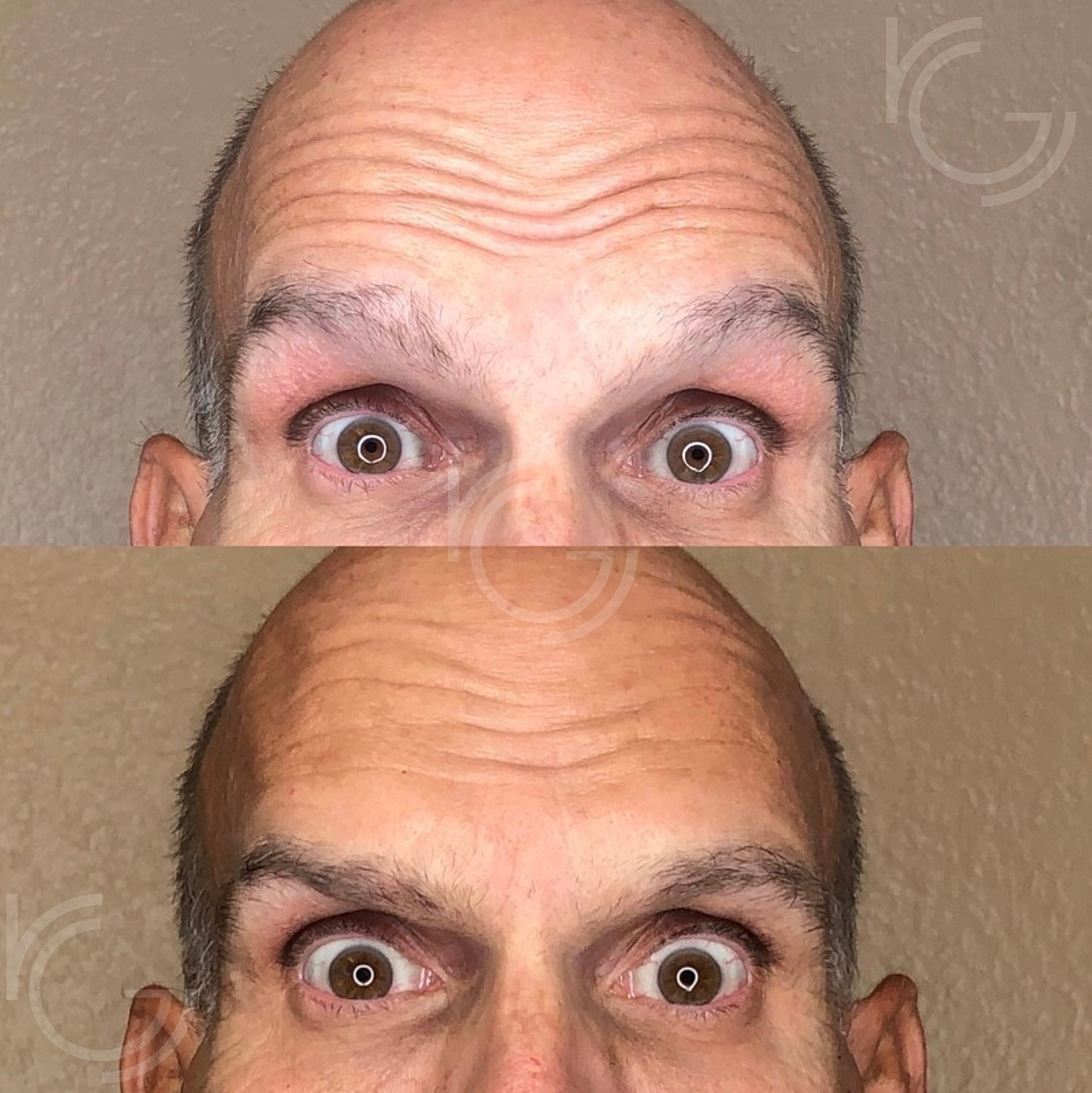Botox Before & After