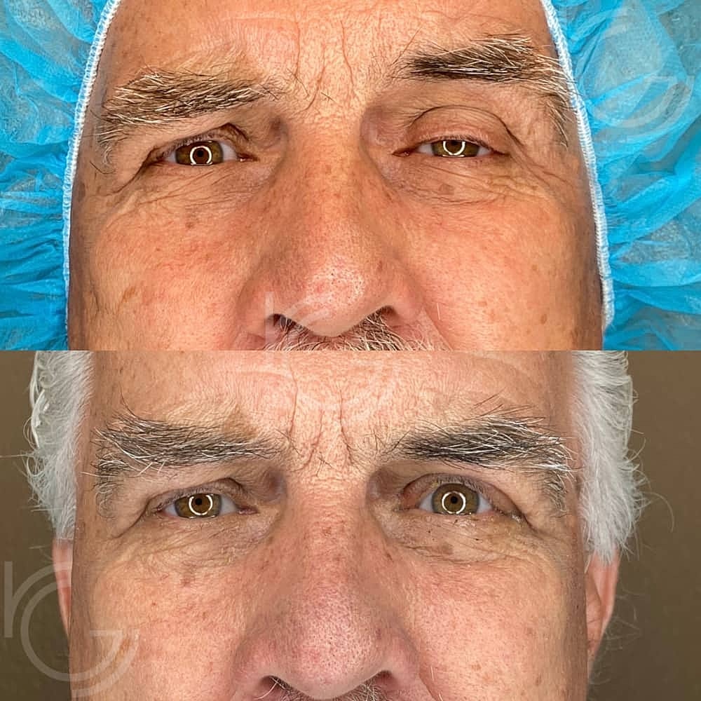 Ptosis Before & After