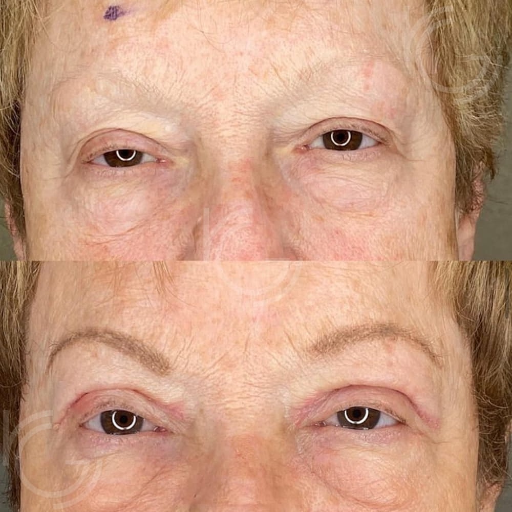 Ptosis Before & After