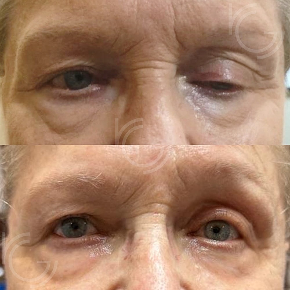 Ptosis Before & After