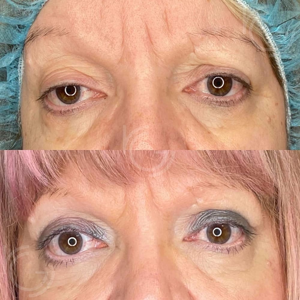 Ptosis Before & After