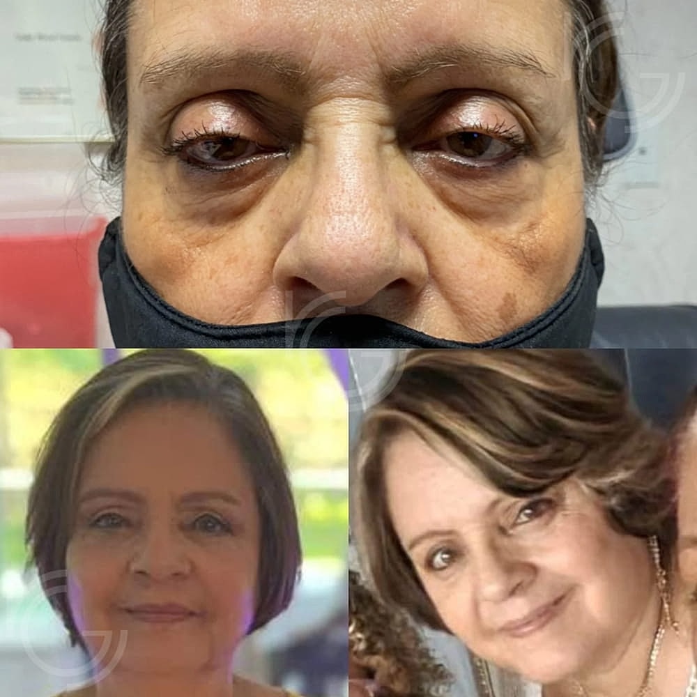Ptosis Before & After