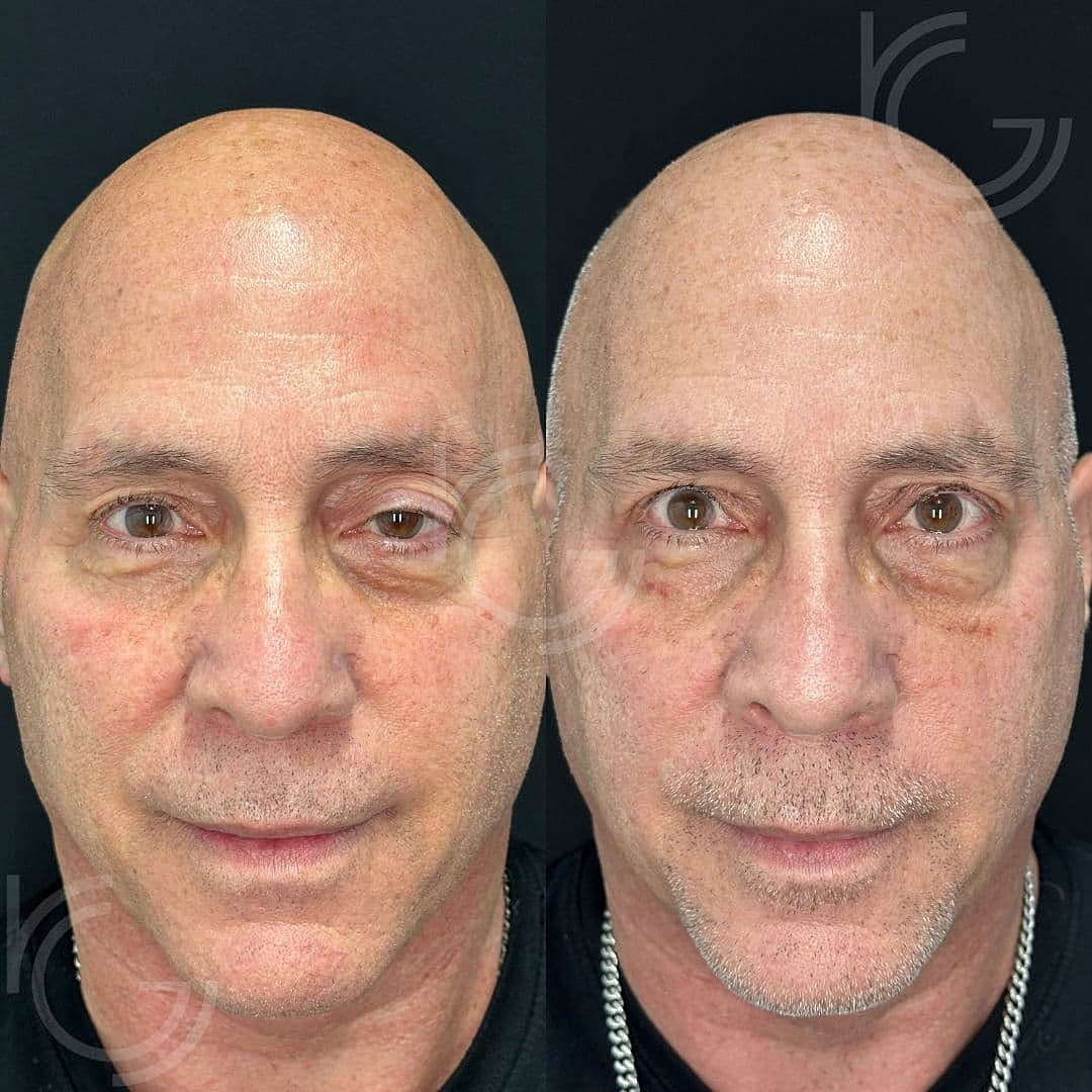 Eyelid Surgery Before & After
