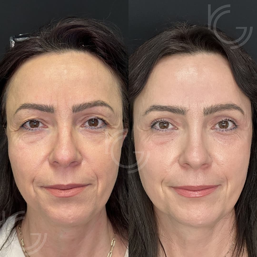Eyelid Surgery Before & After