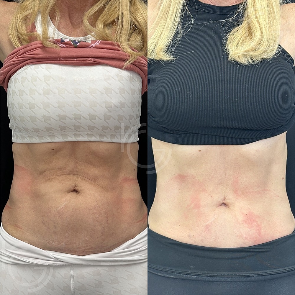 Emsculpt Neo Before & After