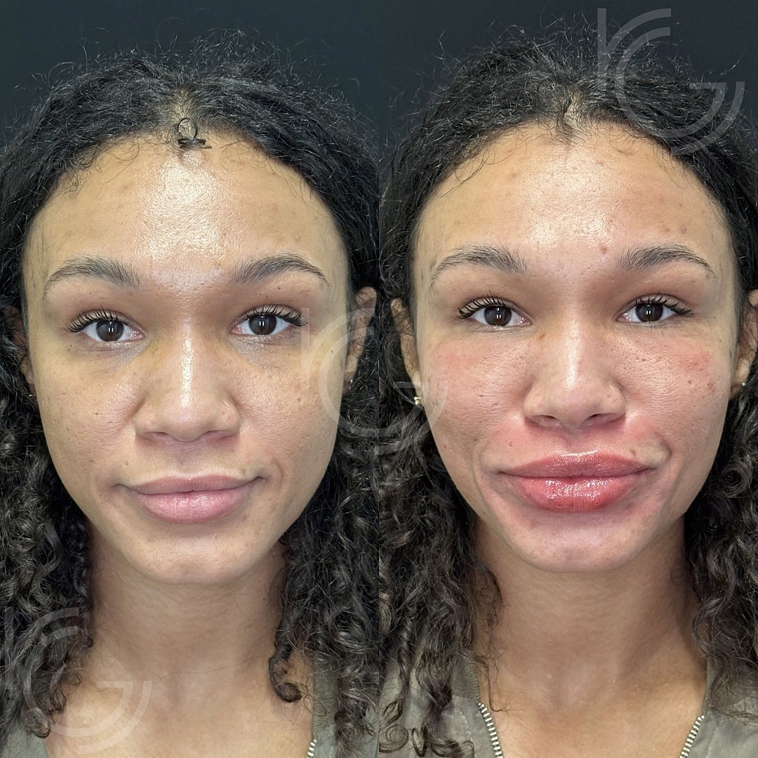 Cellenis Before & After