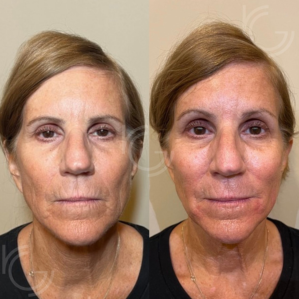 Cellenis Before & After